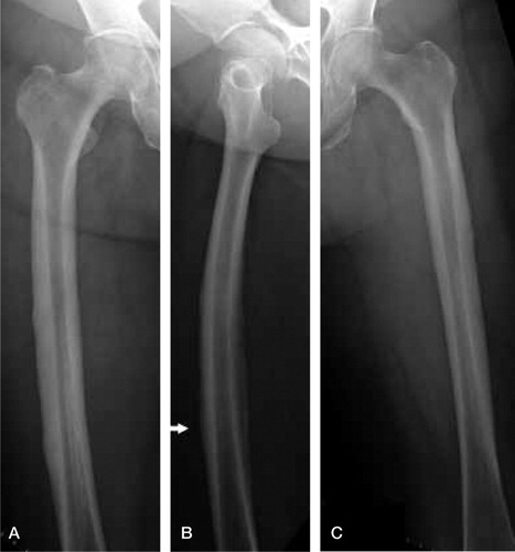 Figure 1. Right (A) and left (C) femur showing lateral cortex thickening. Right femur also showing an undisplaced fracture (B; arrow).