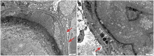 Figure 6. Electron microscopy: Irregular thickening of the basement membrane and segmental double-track formation was observed in the renal specimen.
