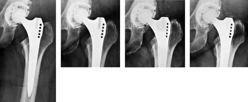 Figure 3. A) 50 year–old woman. Postoperatively. B) 1.5 years postoperatively. There was an RL of nearly 2 mm in zones 1 and 7. The boundary of the RL is a regular formed dense line (RD) corresponding to the preexisting bone stock, and running parallel to the implant surface. Atrophy of the medial cortical bone at zone 7. C) 4.5 years postoperatively. No change of RL and RD compared to B. At the distal end of the lines there is a small area of sclerosis. D) 10 years postoperatively. No change except a slight increase in the sclerosis in zone 7, thus reducing the extent of the RL and RD.