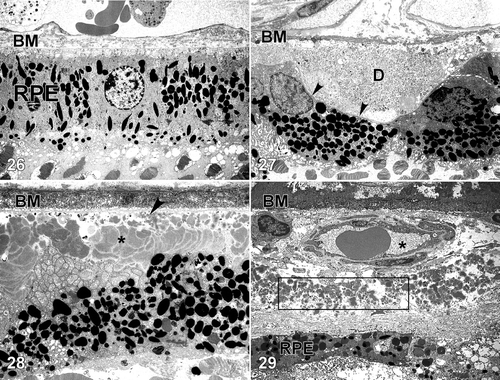 Figures 26–29. Transmission electron micrographs of the retinal pigment epithelium(RPE)‐choroid interface in eyes of donors without (Figure 26) and with (Figures 27–29) a clinically documented history of age‐related macular degeneration (AMD). A single druse (D) is shown in Figure 27; its location between the RPE basal lamina (arrowheads) and Bruch's membrane (BM) is clearly indicated. BLamD (asterisk) accumulates between the basal surface of the RPE and its basal lamina (arrow), whereas BLinD is located within the innermost aspect of Bruch's membrane (Figure 28). A patent choroidal neovessel (asterisk), lying between BM and a layer of BLamD (rectangle), is shown in Figure 29. RPE = retinal pigment epithelium; BM = Bruch's membrane.