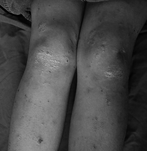 Figure 1.  Erythematous, hyperkeratotic plaques with silvery squames on the extansor surfaces of knees.