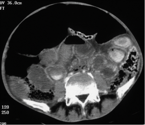 Fig. 3.  Late axial abdominal computed tomography scan showing pneumatosis intestinalis, intra-peritoneal effusion, and pneumoperitoneum.