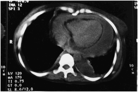 Figure 1. Illustrates pericardial effusion with thickened pericardium and bilateral pleural effusion.