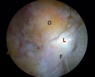 Figure 3. View of the peripheral compartment from the anteromedial portal with a 30º scope. The close relation between the detached labrum (L) and the “os acetabuli” (O) can be seen. F: femoral head.