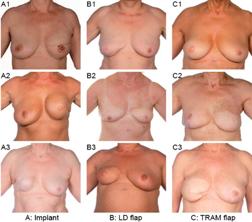 Figure 3. Postmastectomy breast reconstruction and common complications. A is reconstructions with implants. A2-3. Capsular contracture and loss of symmetry. B. Reconstructions with the LD flap. B2-3. Inferior color and size match. C. Reconstructions with the TRAM flap. C2-3. Insufficient skin color match and retraction after necrosis. Courtesy Department of Clinical Photo, Aarhus University Hospital, Denmark.