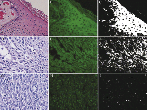 Figure 2. Tumor and skin ablation: Non-viable, ablated skin (A,B,C) and rabbit VX2 carcinoma (D,E,F). Ablated non-viable skin (A,B,C) exhibits increased autofluorescence, and remains white in filtered image. Non-viable tumor cells are strongly autofluorescent, and are white in filtered image. Viable VX2 carcinoma cells (G,H,I) fluoresce less strongly and remain black in filtered image. H&E (A,D,G), fluorescent (B,E,H), filtered (C,F,I), 400× magnification.