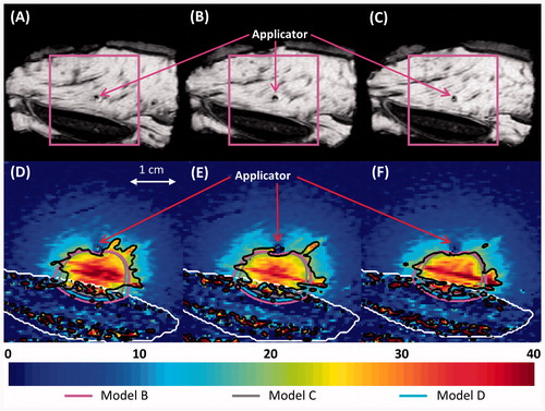 Figure 12. (A–C) MR images of the three central heated axial slices of ex vivo bovine rib, spaced 5 mm apart. (D–F) Colour map of temperature increases (°C) recorded with MRTI is shown in a smaller field of view (magenta box) for each slice 5 min into the ablation. Bone is outlined with a white line, and the 20 °C temperature increase contours recorded by MRTI are outlined in black. Also shown are the 20 °C temperature increase contours produced by models B (magenta), C (grey), and D (cyan).