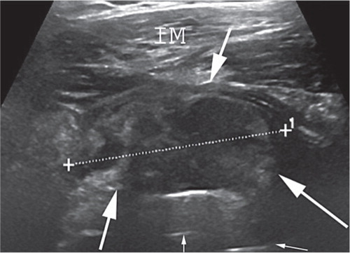 Figure 3. Example of an ultrasound finding classified as a solid pseudotumor. An anterior image showing a solid pseudotumor (arrows) dislocating the iliopsoas muscle anteriorly. The thin arrows show the prosthesis. IM: iliopsoas muscle.