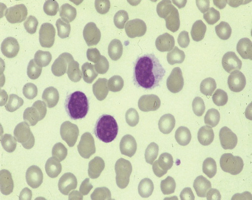 Figure 1. May Grunwald Giemsa stained peripheral blood film from a patient with HCL showing circulating hairy cells.