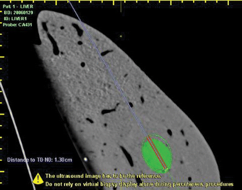 Figure 2. In two insertions we have done an accuracy evaluation, performing an insertion at high depth, of the Virtual Navigator estimation (distance between needle tip and lesion).