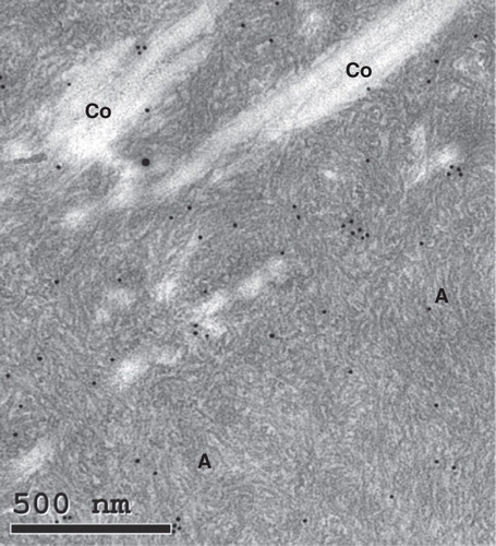 Figure 2. Electron micrograph of ligament with transthyretin-amyloid deposits (A) with typical fine fibrillar appearance, intermingled with collagen fibers (Co). The section was immunolabeled for transthyretin and reaction visualized with 10 nm gold particles. Bar 500 nm.
