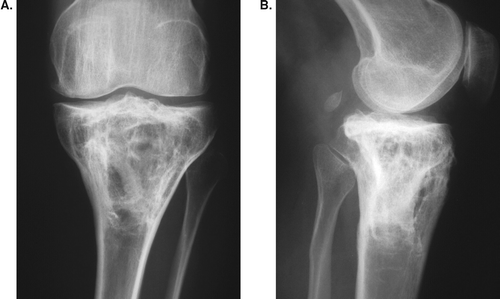 The same patient 9 years after surgery. She developed osteoarthritis during the follow-up.