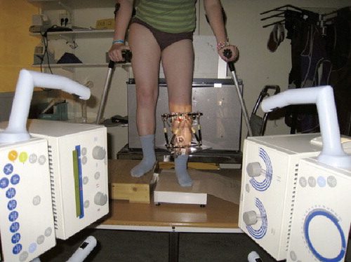 The standard examination setup with the patient in standing position and weight bearing recorded on a scale for RSA measurement of callotasis subsidence.