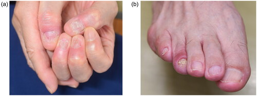Figure 3. (a,b) Clinical finding after52 weeks of deucravacitinib treatment. (a) and (b) show complete remission of skin and nail disease.