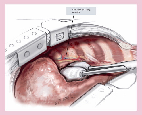 Figure 1. Extrapleural pneumonectomy: chest retractors are placed to increase the initial exposure of the tumor.Reprinted with permission from Citation[69].