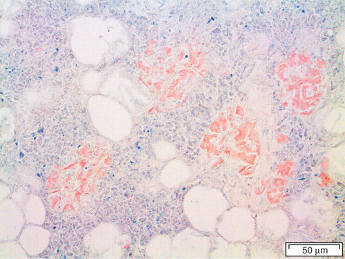 Figure 1. Pancreatic section of case IsN13 with islets filled with amyloid, stained with Congo red. This material was used to purify the IAPP giving the first amino acid sequence from human islet origin. There are signs of pronounced autolysis, which did not affect the quality of the purified peptide. There was also partial exocrine atrophy which was helpful in that it made the amyloid more concentrated.