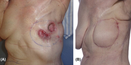 Figure 1. (A) Fourth-time local recurrent breast cancer to the left hemithorax. (B) 80 days after full-thickness chest wall reconstruction.