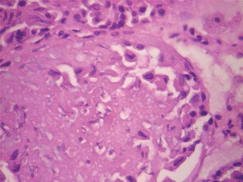 Figure 9.  Histopathologic presentation of rat testes of CF 1000 mg/kg group (Inflammation/necrosis; 400×).