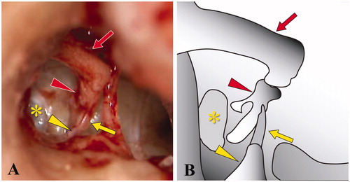 Figure 2. Intraoperative image of the middle ear in case 1. (A) The post-tympanotomy image shows the stapes superstructure attached to the promontory without formation of the stapes footplate. (B) Schema of findings in the ossicular chain and related structures. Red arrow: long process of incus, red arrowhead: stapes superstructure, yellow asterisk: oval window, yellow arrow: tendon of stapedius, and yellow arrowhead: pyramidal eminence