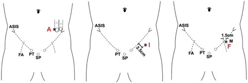 Figure 2. Illustration of 3 landmarks for determination of the center of the femoral head: A (left panel); I (center panel); F (right panel). ASIS: anterosuperior iliac spine; FA: femoral artery; PT: pubic tubercle; SP: symphysis pubis.
