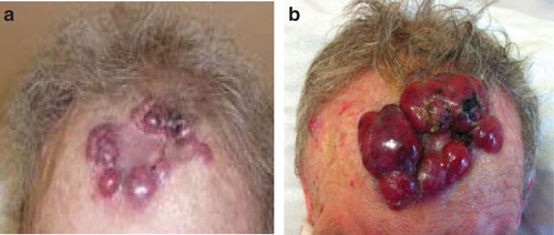 Figure 1. (a) Cutaneous dome shaped nodules peripherally located on the full thickness skin graft, three weeks after excision of squamous cell carcinoma (b) 7 days later, rapid growth and ulceration of the lesions expanding beyond the graft site.