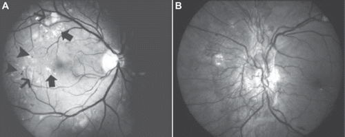Figure 3. A: Moderate non-proliferative diabetic retinopathy with hard exudates (large arrows), soft exudates (small arrows), and microaneurysms (arrowheads). B: Proliferative diabetic retinopathy and neovascularization in the optic disc.