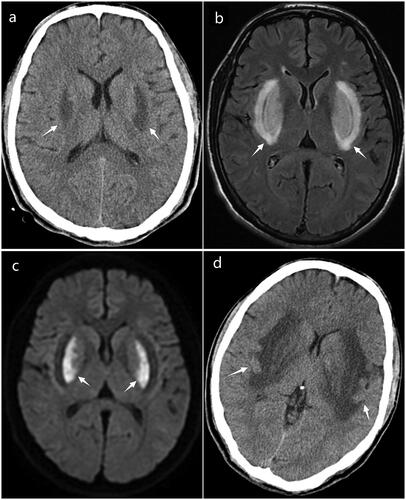 Figure 1. (a) A computed tomography scan taken 20 hours post-admission reveals symmetrical hypodensities in the bilateral basal ganglia (arrows). (b) A magnetic resonance image at 80 hours post-admission, T2-weighted-fluid-attenuated inversion recovery (T2-FLAIR) displays bilateral hyperintensities in the basal ganglia, indicative of the lentiform fork sign (arrows). (c) Diffusion-weighted image (DWI) shows diffusion restriction in the lentiform nuclei (arrows). (d) A follow-up computed tmography scan on day 19 post-admission demonstrates an expanded area of edema with evidence of hemorrhagic conversion (arrows).