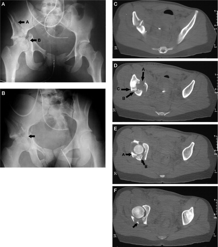 Figure 4. The inverse T-fracture of patient no. 4 is shown in panel A, and arrow A marks the vertical fracture line. Arrow B marks the transverse fracture line. On the oblique iliac view in panel B, the arrow points to the attached ileum with articular cartilage stretching into the joint posteriorly. In panel C, the vertical fracture is shown and both the vertical (A) and transverse (B) fracture lines are pointed out in panel D. The scan also shows comminution with an additional fragment marked C between the attached and unattached ileum. The posterior wall fragment is marked A in panel E and the arrow B points to attached ileum with articular cartilage. The most distal part of the attached ileum is marked in panel F. There are no fracture lines into the foramen obturatum.