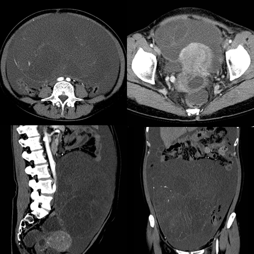 Figure 1 CT of the abdomen and pelvis demonstrating the pelvic mass and large ascites.
