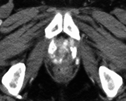 Figure 1. Example of an unenhanced computed tomography scan obtained one year after a single injection of magnetic fluid into the prostate, followed by six thermotherapy treatments. Hyperdense nanoparticle deposits in the prostate are still visible.