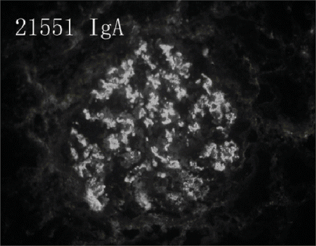 Figure 2. IgA deposition on mesangial area in IF.