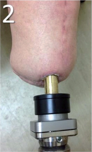 Figure 3. Skin-implant interface for case 2.