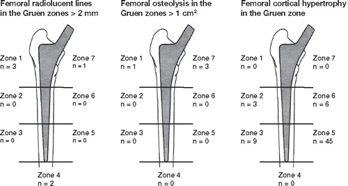 Figure 4.  Localization and incidence of femoral radiolucent lines, femoral osteolysis, and cortical hypertrophy.