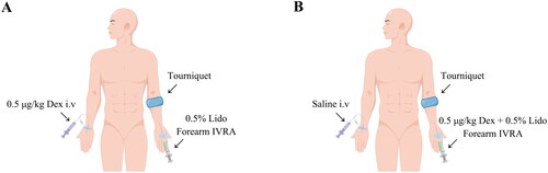 Figure 1. Schematic diagram of lidocaine forearm IVRA. Abbreviations: IVRA: intravenous regional anaesthesia; Dex: dexmedetomidine; Lido: lidocaine.