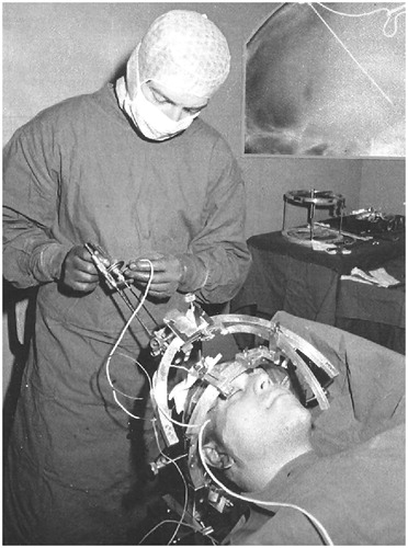 Figure 1. A neurosurgeon performing a stereotactic procedure at the hospital “Istituto Neurologico Carlo Besta” in Milan in the early 1980s.