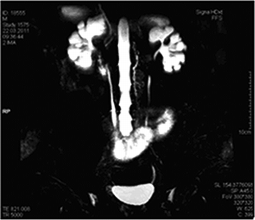 Figure 1.  Magnetic resonance urography revealed calyceal dilatation, increased number of calyces, and normal ureters and bladder.