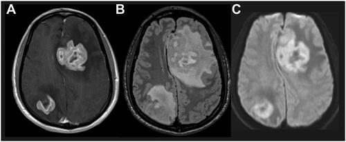 Figure 1. Characteristic PCNSL imaging pattern on magnetic resonance imaging. A) T1 sequence with gadolinium contrast demonstrates enhancing brain lesion. B) Fluid-attenuated inversion recovery sequence visualizes a mass edema surrounding the mass lesion. C) Diffusion-weighted imaging demonstrates restricted diffusion within the tumor lesions. Abbreviation: PCNSL, primary central nervous system lymphoma.