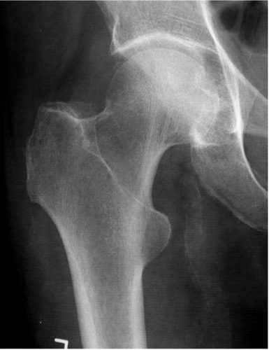 A conventional radiograph interpreted as being negative. In retrospect, it may be possible to see an irregularity in the proximal cortex of the femoral neck.