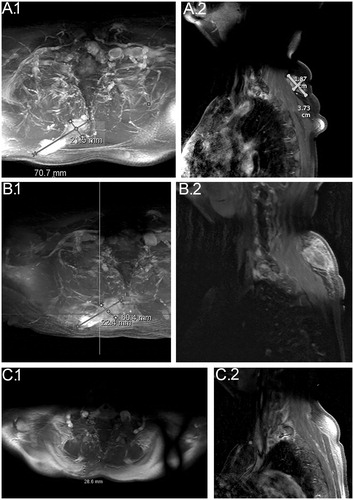 Figure 2. MRI before, during and after the treatment period. (A) (1 and 2): January 2016; baseline before the first treatment with electrochemotherapy, the tumor is measuring 7.1 × 2.2 cm. (B) (1 and 2): March 2016; after the first treatment with electrochemotherapy, the tumor is measuring 6.0 × 2.2 cm. (C) (1 and 2): January 2017; 1-year follow-up after the second treatment with electrochemotherapy. The tumor is measuring 2.9 × 1.7 cm.