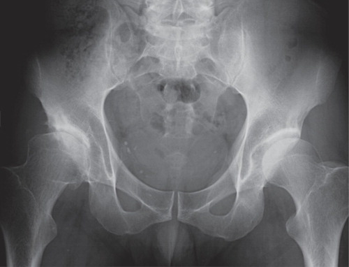 Long-term follow-up radiograph of a 44-year-old man where there was discrepancy between the observers in the assessment of the right hip. Using the minimum JSW method, observer 1 found no OA (a minimum JSW of 3.2 mm) whereas observer 2 found OA (a minimum JSW of 1.8 mm). Both observers found severe OA by Kellgren and Lawrence (grade 3) and Croft (grade 4).