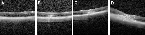 Figure 9 Optical coherence tomography images of the CNV.Notes: (A) Normal structure of the retina and the choriocapillaries of rats before photocoagulation; (B) 7 days after photocoagulation; (C) 14 days after photocoagulation; and (D) 21 days after photocoagulation.Abbreviation: CNV, choroidal neovascularization.