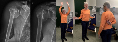 68-year-old female suffering an impacted 2-part fracture of the proximal humerus. Radiographs were taken on admission and after 5 months. Clinical photos were taken after 5 months. Pain-free shoulder function was obtained after 3 months. In this case intuition will tell most orthopedic surgeons to restore the anatomy, most likely by open reduction and internal fixation with a locking plate. Best evidence from randomized trials does not support this decision (Rangan et al. Citation2015, Launonen et al. Citation2019). How to act?