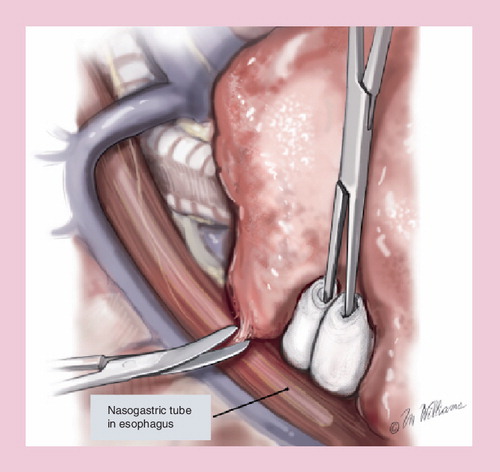 Figure 2. Extrapleural pneumonectomy: a nasogastric tube is inserted in the esophagus to prevent injury while the tumor is being resected off the esophagus.Reprinted with permission from Citation[69].