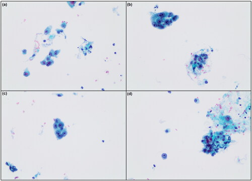 Figure 2. (a–d) FNAC of the case. Malignant endothelial cells are arranged in loosely cohesive clusters admixed with erythrocytes (E) (Papanicolau ×200).