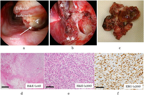 Figure 2. (A) The tumor was in the inferior meatus and was in contact with the inferior turbinate and middle turbinate. (B) Appearance after resection of the tumor. The middle turbinate (*) and inferior turbinate (**) were also resected. No characteristics of malignancy were found. (C) The resected tumor. (D) Specimen stained with hematoxylin and eosin (H&E; ×40), showing sheets of atypical spindle cells. Scale bar: 50 μm. (E) Stained specimen (H&E, ×200), showing several mitotic figures. Scale bar: 100 μm. (F) Immunohistochemical staining for erythroblast transformation-specific-related gene (ERG; ×200). Tumor nuclei are positive for ERG, which is highly expressed in endothelial cells. Scale bar: 100 μm.