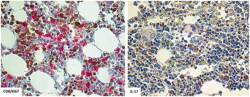 Figure 6. Trephine biopsy taken at the beginning of relapse. Note CD8+ cell (red) in close proximity to Ki67+ blasts (left panel) and IL-17-producing cells (right panel).