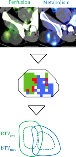Figure 1. Target definition workflow: parametric images (top) produce respective threshold regions (middle), and clinical margins are applied (bottom). Perfusion is in green, metabolic rate in blue, and overlap in red.
