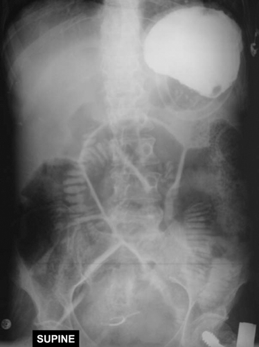 Fig. 1.  Anteroposterior abdominal radiograph showing laminated edge in small bowel and colic distension. The film shows opacification from trichlorethylene remaining in the stomach since trichlorethylene is radiopaque.