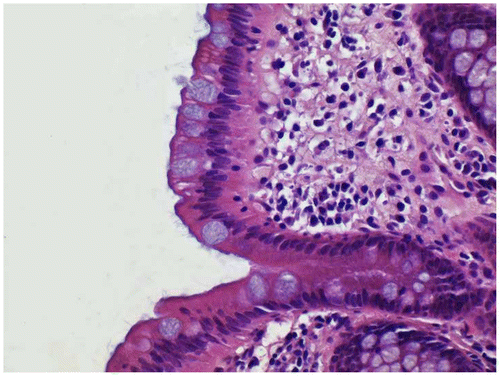 Figure 4 Rectal biopsy stained with iron alum celestine blue and eosin-erythrosin, x40. Mucin is stained blue.