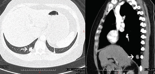 Figure 3. Chest computed tomography showing a 1.5-cm pulmonary nodule with spiculated margin in the right lower lobe (arrow).